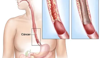  El abuso del consumo de carnes rojas y tomar bebidas muy calientes (té o café), son factores de altos riesgos del cáncer de esófago
