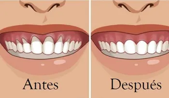 11 remedios caseros para arreglar las retracción de encías