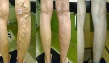Sana tus venas varicosas con Aloe, Zanahoria y Vinagre de Manzana 