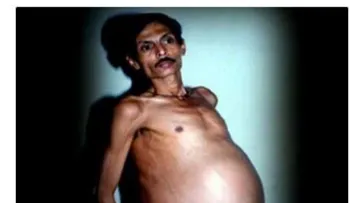 ¡Entérate del insólito caso médico de este hombre!
