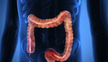 5 puntos acerca del cáncer colorrectal   