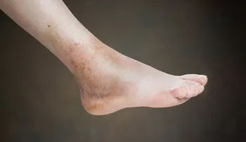 Pies y manos hinchados por la mañana