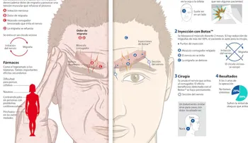 Migraña crónica, más de 800 mil afectados: La mitad de los pacientes se automedican sin receta