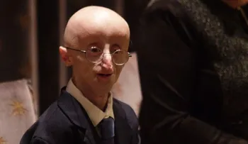 Muere a los 17 años joven con rara enfermedad de envejecimiento