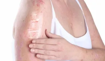 Psoriasis: El aislamiento y el estrés agravan las lesiones