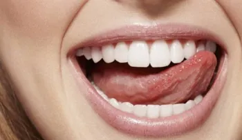 Los 10 alimentos muy habituales que destrozan tus dientes