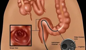 4 tips para prevenir el cáncer de colon