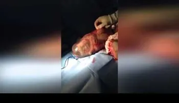 Un bebé nació dentro de su saco amniótico, ¡y los médicos se maravillaron! (VIDEO)