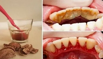 No te pierdas este sencillo remedio para olvidarte de la placa y el sarro fácilmente