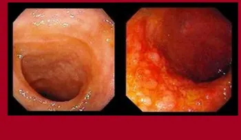 Hallan una forma más efectiva para tratar enfermedad de Crohn