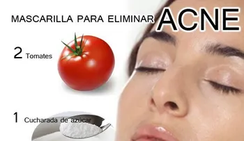Los tomates curan el acné