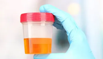 Orinar espumoso puede ser síntoma de una patología renal
