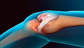 Doctores no lo pueden creer: Receta Renueva las Rodillas y Articulaciones Naturalmente