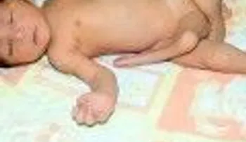 Nace bebe con seis piernas en Pakistán