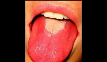 10 enfermedades que puedes adquirir con un beso