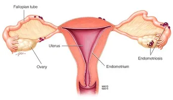 Endometriosis: Una infección que afecta ovarios, trompas de Falopio y pelvis de la mujer