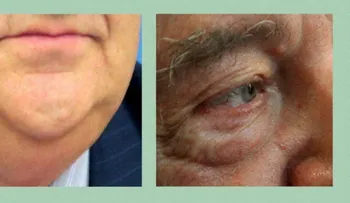 Papada y bolsas de ojos, principales complejos en los hombres