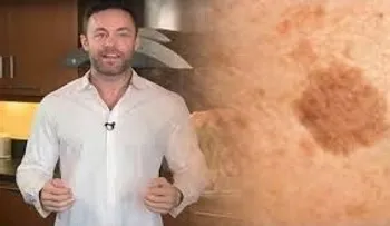 Famoso dermatólogo revela cómo quitar los puntos marrones de la cara y la piel con este simple truco