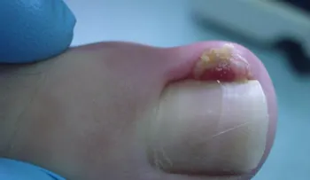 Fantásticas recetas para tratar y curar las uñas encarnadas