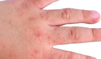 Tratamiento natural para la erupción cutánea