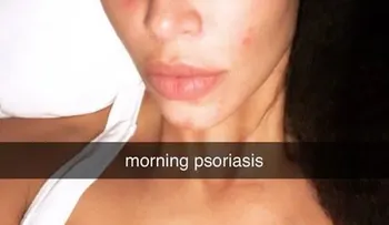 Kim Kardashian deja al descubierto marcas en su piel por enfermedad incurable 