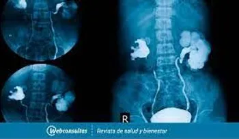 Urografía excretora: Un examen para detectar sangre en la orina, piedras en los riñones o vejiga y cáncer en el tracto urinario