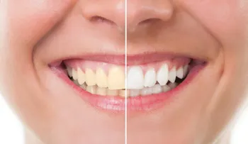 Blanqueamiento dental en sólo 3 minutos 