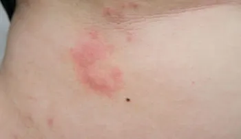 El ajo puede quemarte la piel si no sabes como usarlo