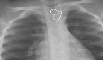 Doctores están atónitos por insólito caso de niña con dos corazones en el pecho