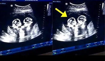 Gemelas se "pelean" en el útero de su madre; capta una ecografía 