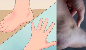 Con este remedio me alivie del edema al 100%