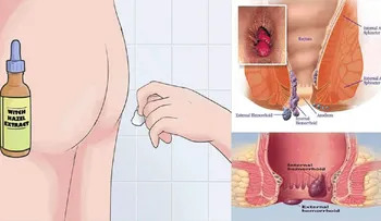 Los doctores aun no encuentran la explicación de porqué esto corta la hemorroide en 20 minutos!!!