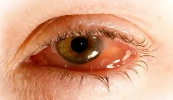 La higiene es vital para la salud ocular
