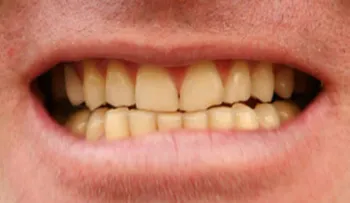 8 alimentos que causan dientes amarillos