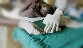 Dispositivo israelí permite circuncidar a 700.000 ruandeses y prevenir el SIDA.