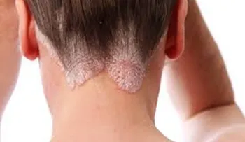 Alteraciones metabólicas: Comorbilidades más frecuentes de la psoriasis