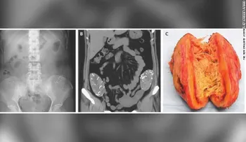 Encuentran dos esponjas dentro de una mujer 6 años después de operarla