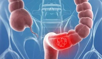 El cáncer neuroendocrino puede surgir en cualquier parte del cuerpo
