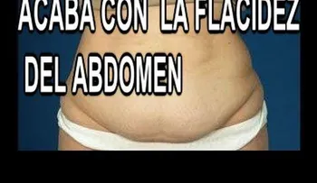 Piel colgada luego de perder 160 libras (Video)