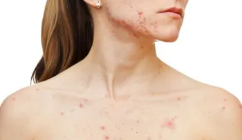 Remedio efectivo para eliminar el acné del pecho y espalda