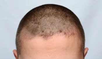 Tratamientos naturales para la dermatitis seborreica