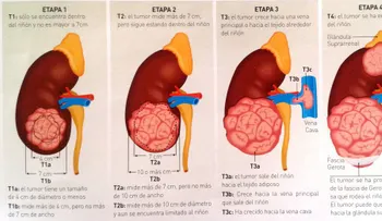 Cáncer de riñón y 10 maneras de reducir el riesgo