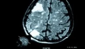 Causas de los tumores cerebrales