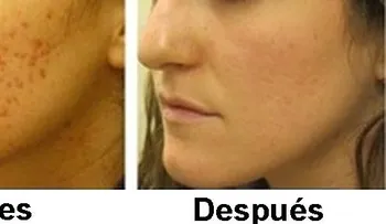 Cómo quitar las cicatrices de acné