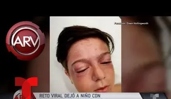 Un niño queda con lesiones cerebrales tras someterse a peligroso reto viral