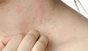 Casos de escabiosis bacteriana empeoran por la escasez de agua y antibióticos
