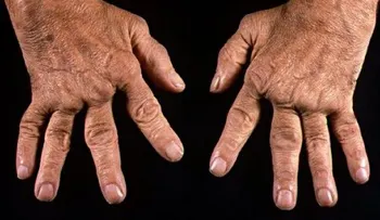 Artritis Reumatoide: Mientras más conocimiento mejor