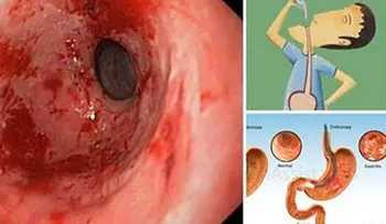 Elimina la acidez y la gastritis de por vida: Solo necesitarás agua de limón, linaza y agua de coco