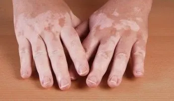 El consumo de nueces y otros 6 remedios para el vitiligo o despimentación de la piel