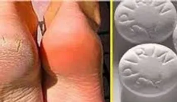 10 aspirinas trituradas con alcohol, y los callos, talones agrietados y venas varicosas desaparecerán